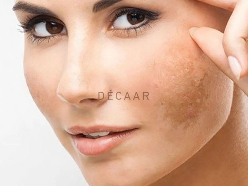 Điều trị rối loạn sắc tố da